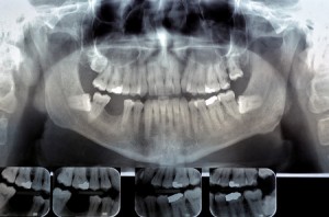 digitales Röntgen, Orthopantomogramm, Zahnfilm, strahlenarm